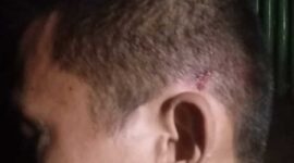 Lesmana wartawan korban penganiayaan Sumatra Utara.